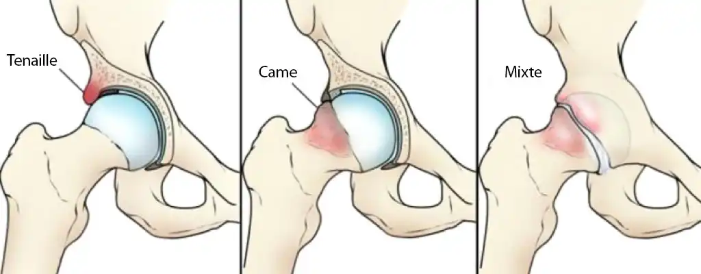 Conflit Fémoro-Acétabulaire (CFA)