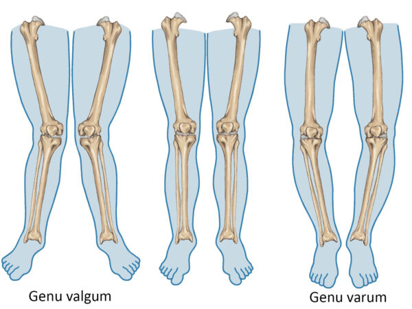 Genu Varum / Valgum