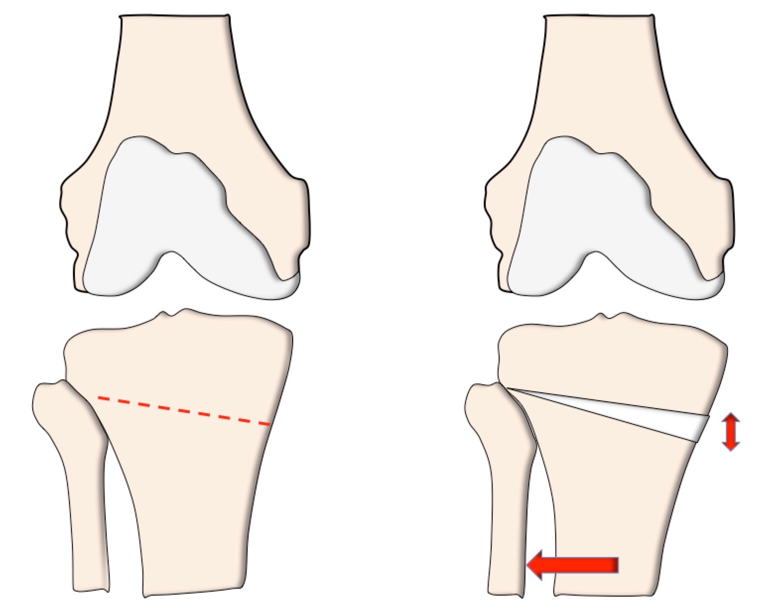 Ostéotomies autour du Genou