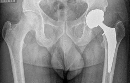 PTH par Voie Antérieure