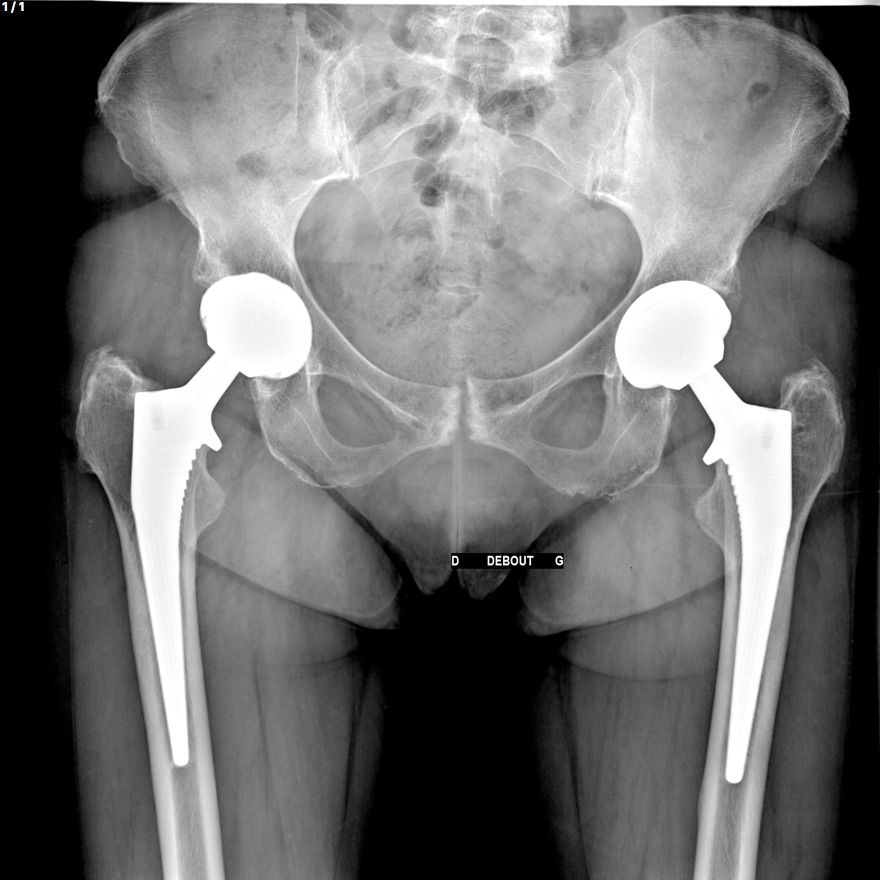 PTH par Voie Postérieure