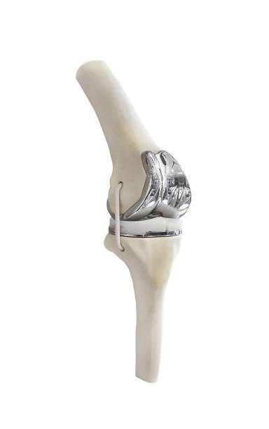 Prothèse Totale de Genou (PTG)