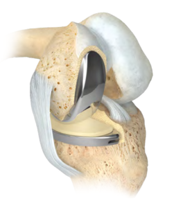 Prothèse Unicompartimentale (PUC)