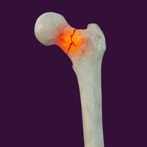 Fracture du Col Fémoral