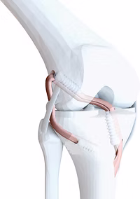 Ligamentoplastie du LCA