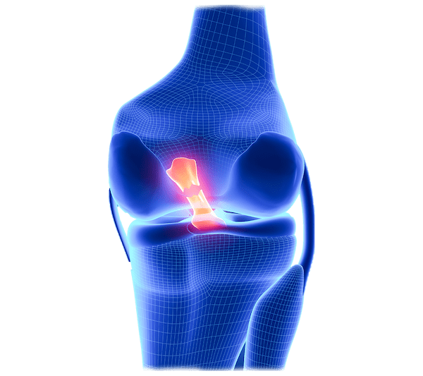 Rupture du Ligament Croisé Antérieur