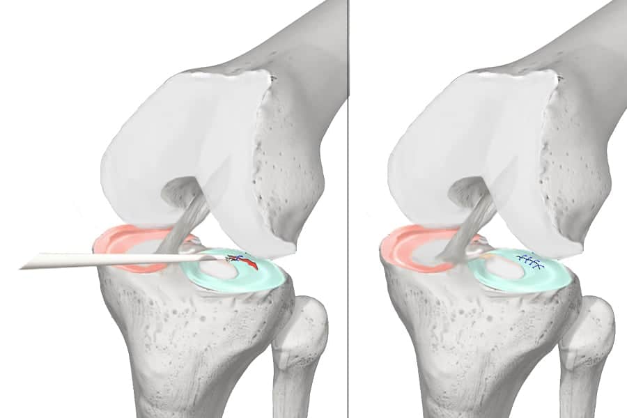 Chirurgie Méniscale